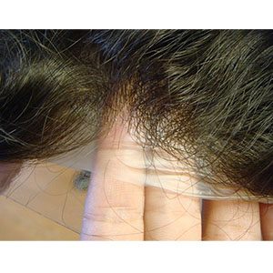partial stock prosthesis indian hair