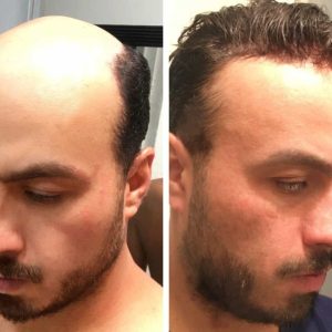 hair replacement systems china