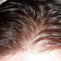Skin Hair prosthesis