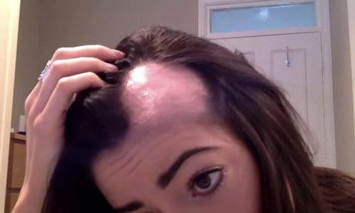 Alopecia and Menopause