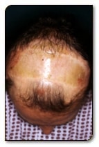 localized alopecia