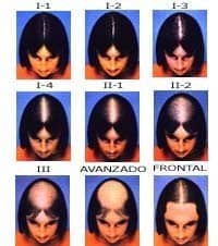 female alopecia