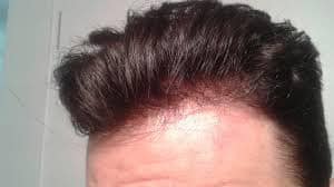 Hair Loss: Causes and Remedies