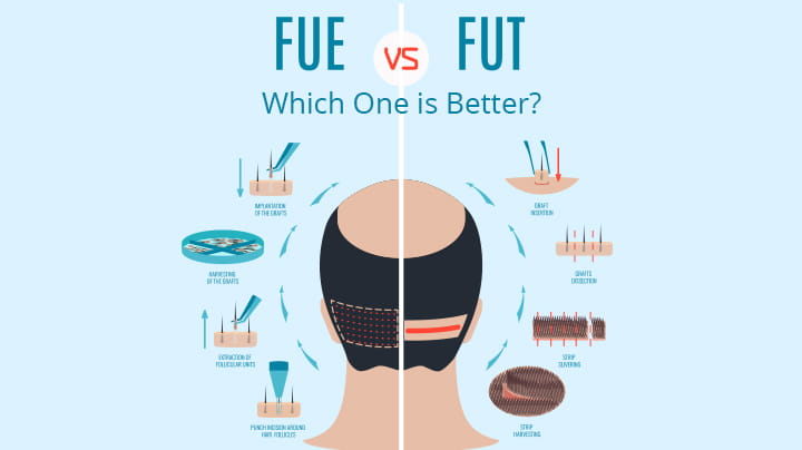 FUE vs FUT Hair Transplant Which Transplant Surgery is Best