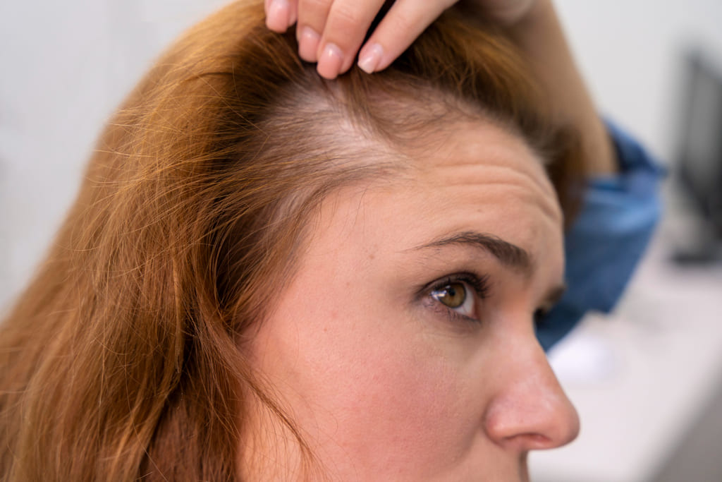 causes of types of alopecia in women