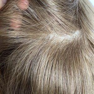 Very thin hair prosthesis
