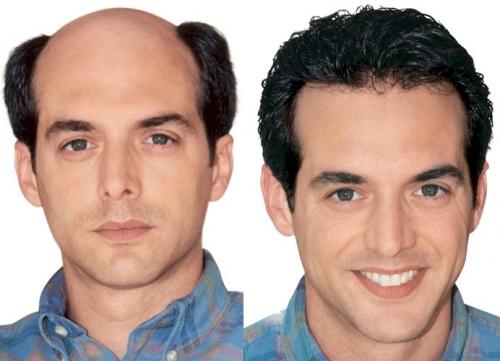hair prosthesis lace systems man